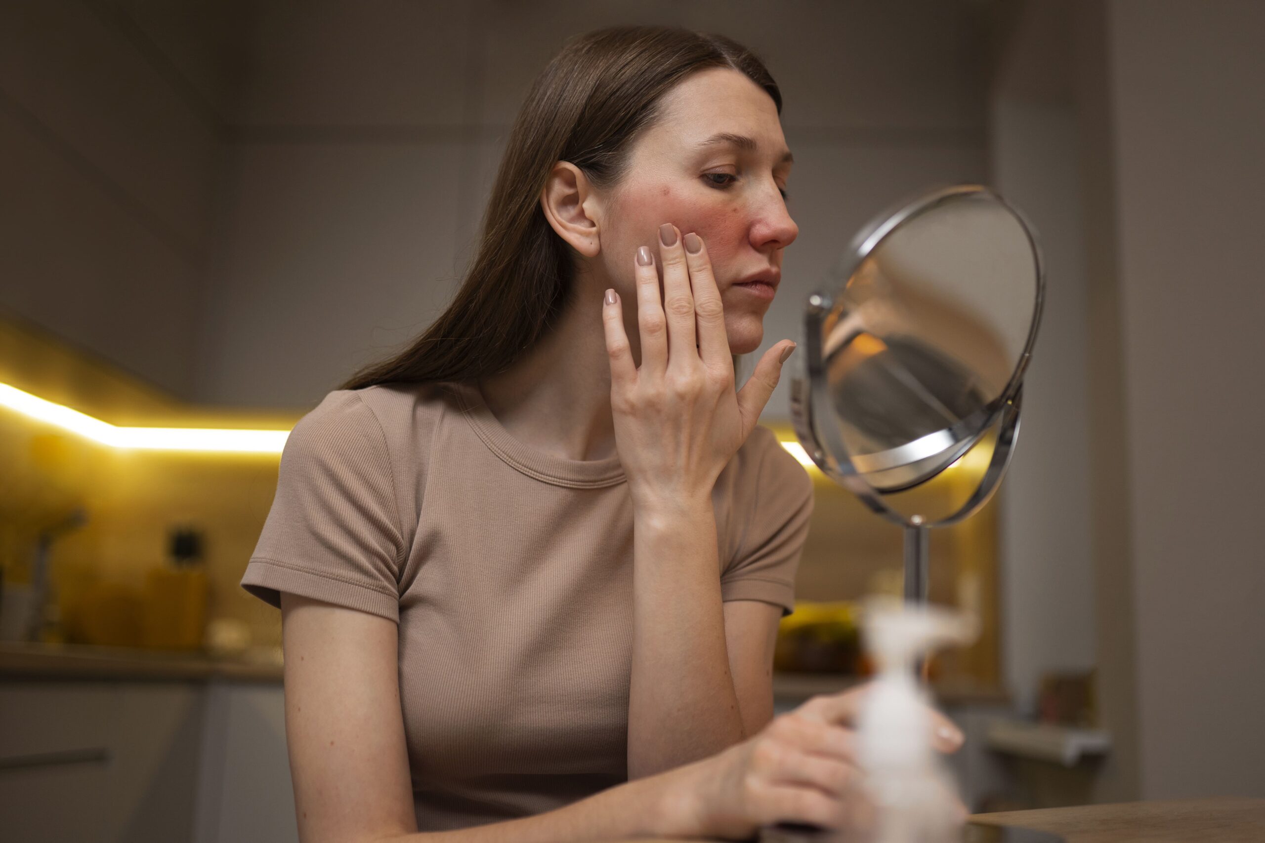 Woman with acne flare-up before using acne laser treatment